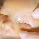 Gözleri olmayan bebek doğdu: Anoftalmi