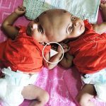 Kafalarından yapışık ikizler için umut ışığı