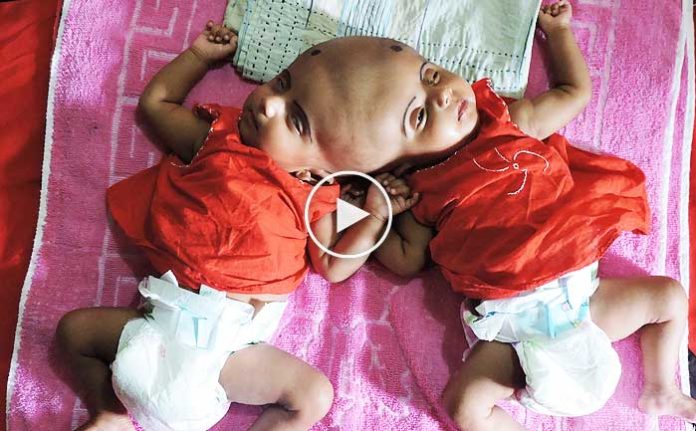 kafalarindan-yapisik-ikizler-icin-umut-isigi-bitisik-kafalar-izle