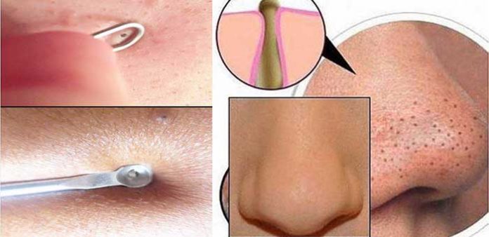 Siyah-lekeler-Vücudumuzdaki-leke-temizleme-maskesi-nasıl-temizlenir-sağlık-haberleri