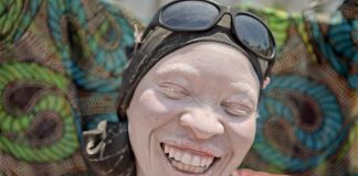 Tanzanya’nın büyücülerden kaçan lanetli halkı: Albinolar