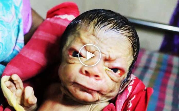 progeria-progeri-erken-yaslanma-hastaligi