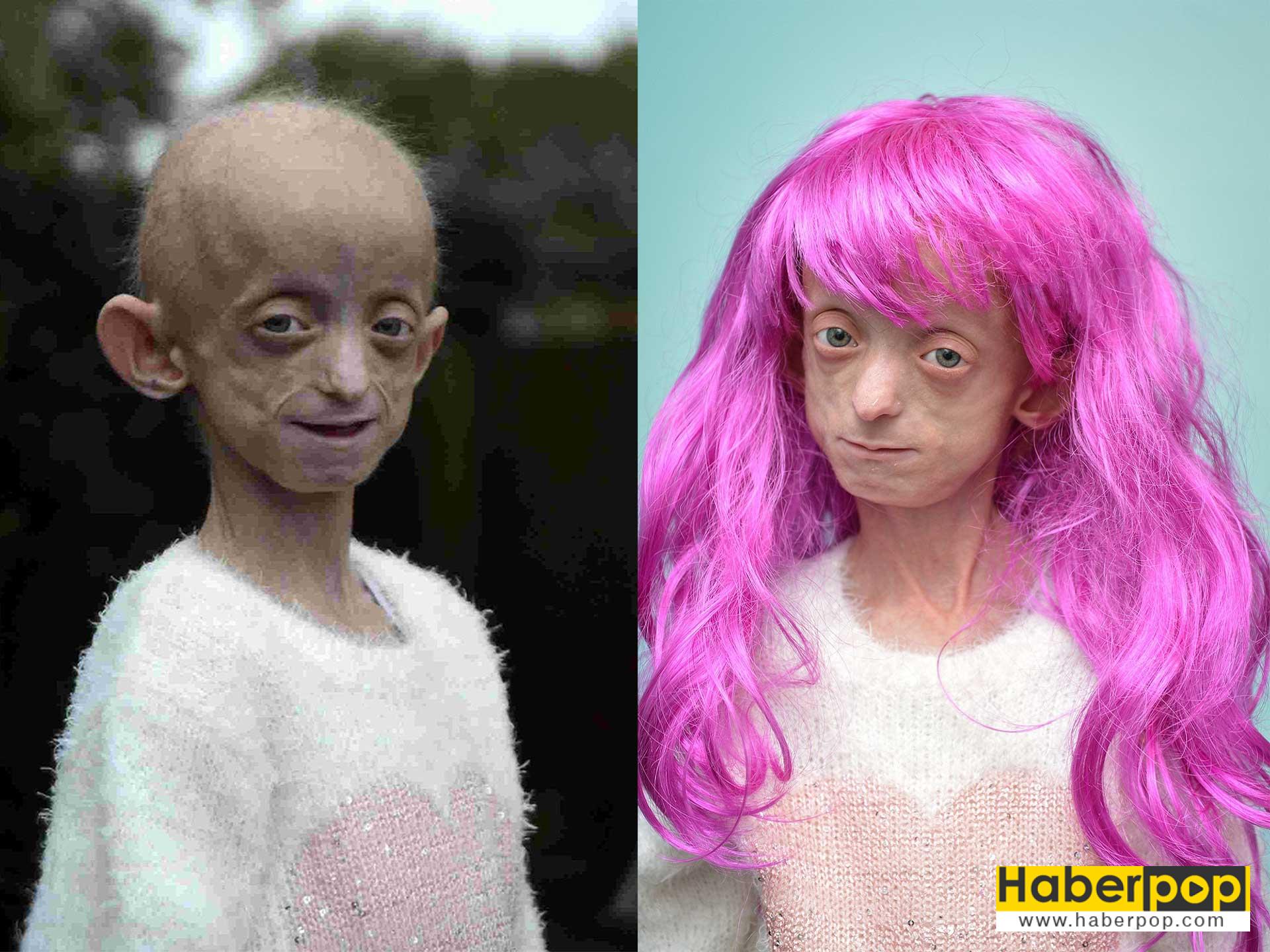 Yaşlı doğan bebek Progeri (Progeria) HaberPop Yaşlı doğan bebek Progeri (Progeria) HaberPop