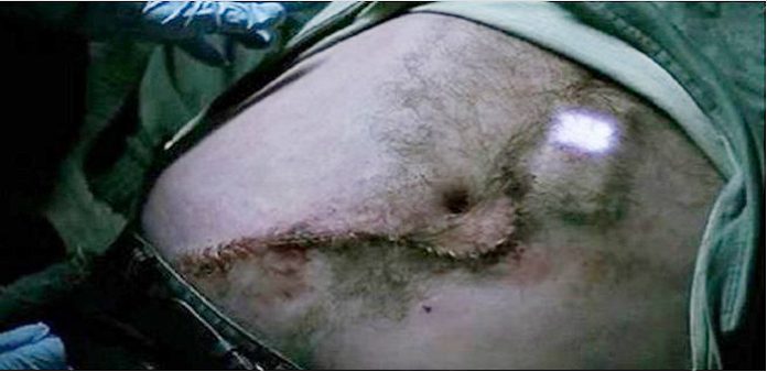 yuttugu-cep-telefonu-midesinden-ameliyatla-cikardilar-video