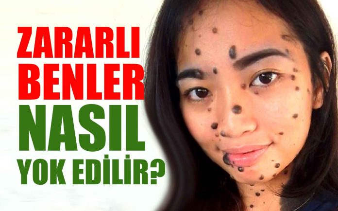 zararli-benler--Yuzdeki-benler-nasil-gecer-vucuttaki-benler-nasıl-gider
